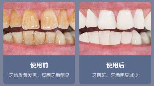 告別刷牙盲區，現代口腔護理新選擇 為何它能解決你的深層困擾